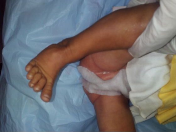 Clinical picture of a newborn’s foot with mild metatarsus adductus