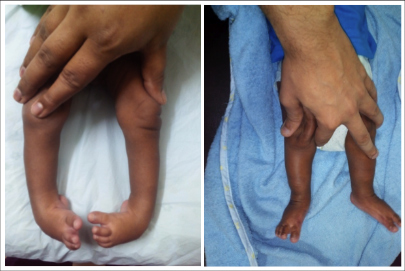 Clinical photograph of a newborn child with congenital clubfoot (a) showing complete correction of the feet after 3 serial plasters and a small suture-less tendon release.