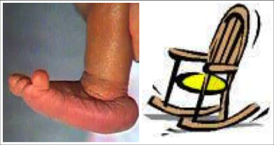 Clinical picture of a newborn with congenital vertical talus(rockerbottom foot) which looks like the bottom of a rocking chair- hence the name.