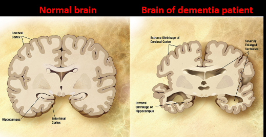 dementia'