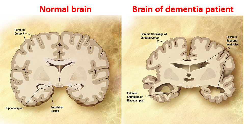 Normal Brain | Brain of Dementia Patient