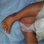 Foot problems in infants