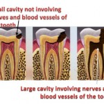 Root Canal Treatment