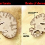 Dementia